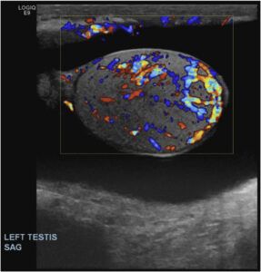 Qué es una ecografía doppler testicular Cleodora Health Consulting